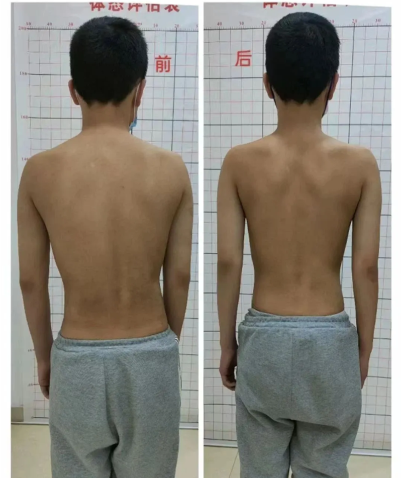 孩子含胸、高低肩？5-18歲暑期脊柱矯正營來救場！_01.png